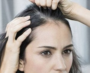 What Is Dandruff